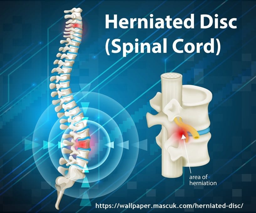 1 slip-disc-treatment-singapore-disc-replacement-sg-doctor
