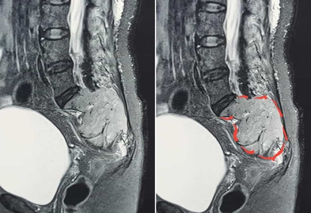 ปวดหลัง ในผู้สูงอายุ เรื่องใหญ่กว่าที่คิด BackacheBonecancer