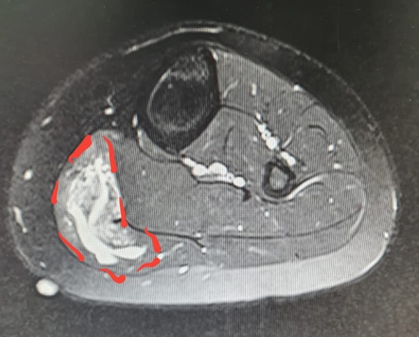 หมอจึงส่งให้ไปตรวจ MRI เพิ่มเติม เพื่อทำการ Scan ผลที่ได้ก็เจอเลยครับ บริเวณวงกลมเส้นประ และหมอได้ทำลูกศรสีแดงชี้ไปยังจุดๆ หนึ่ง สรุปว่าเป็นก้อนเนื้อของเส้นเลือด  ( Hemangia : Vascular Tumour ) ซึ่งอยู่ในกล้ามเนื้อน่องครับ  