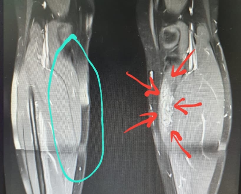ภาพการ mri อาการปวดที่น่อง